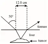 A narrow beam of ultrasonic waves reflects off a liver tumor 